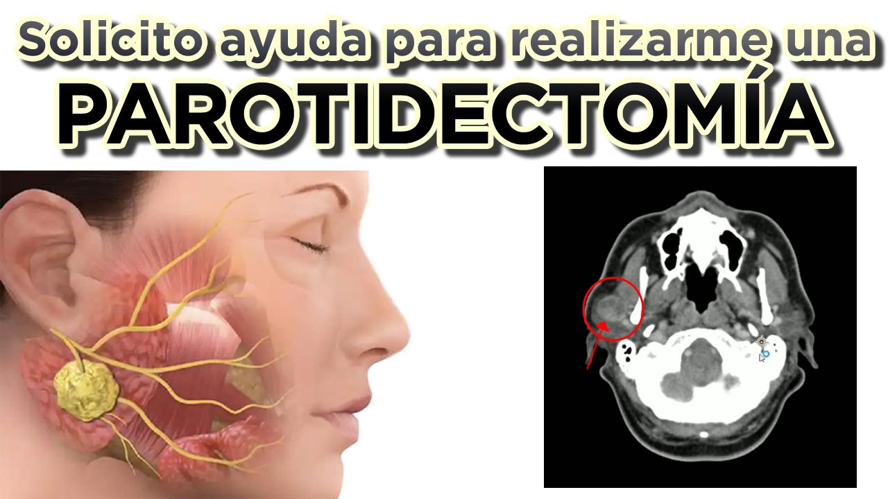 Campaña de Recaudación para realizarme una Parotidectomía